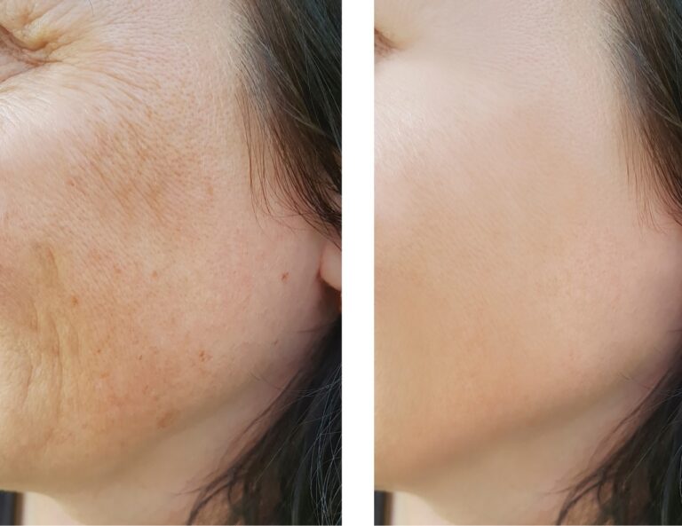 before and after pictures at Ocean Avenue Aesthetics