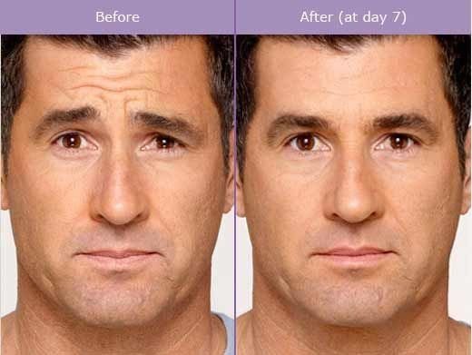 Botox injection before and after photos men